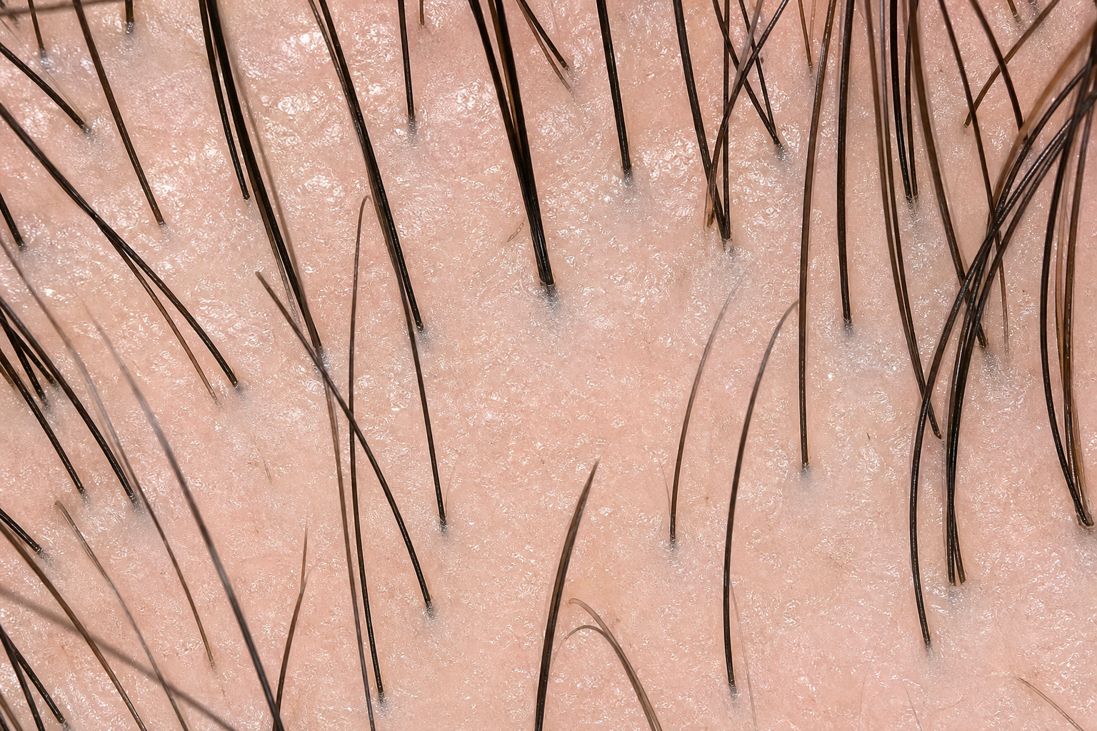 AI hair analysis demonstration showing follicle detection